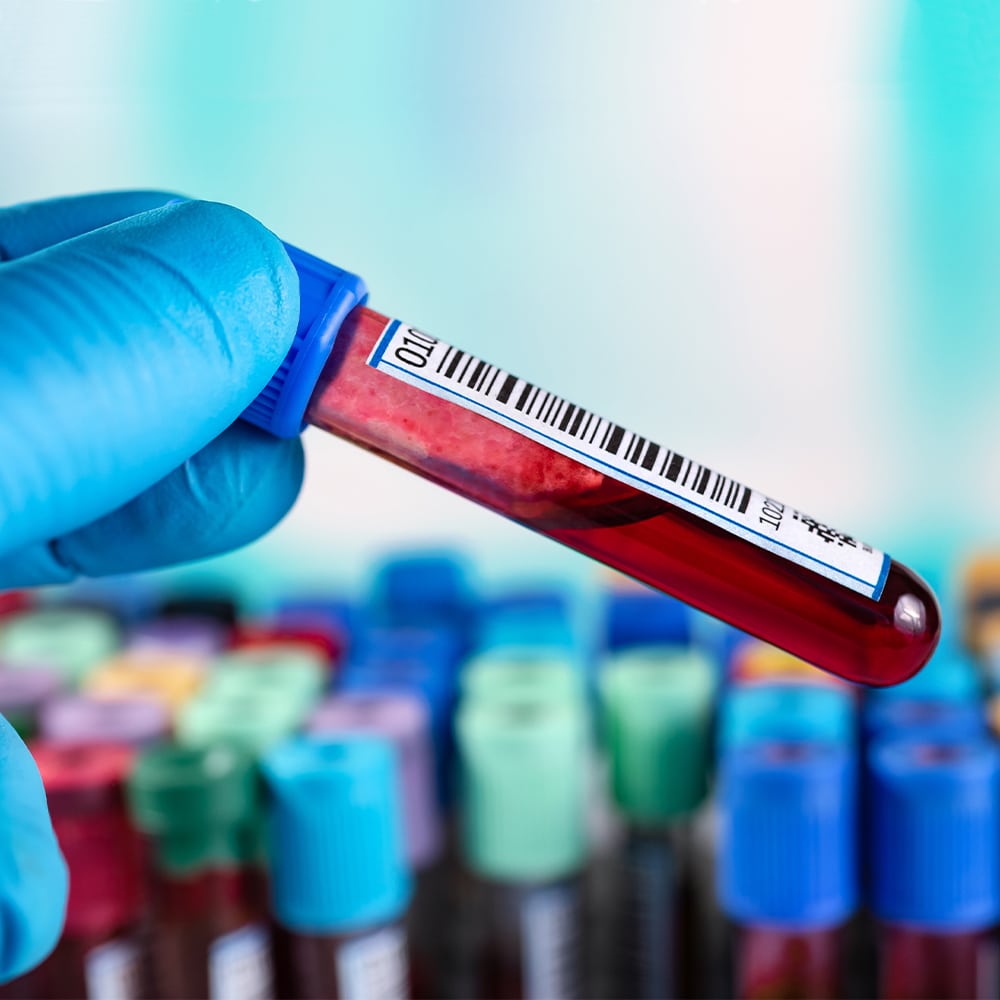 blood test tube testing for hemolysis