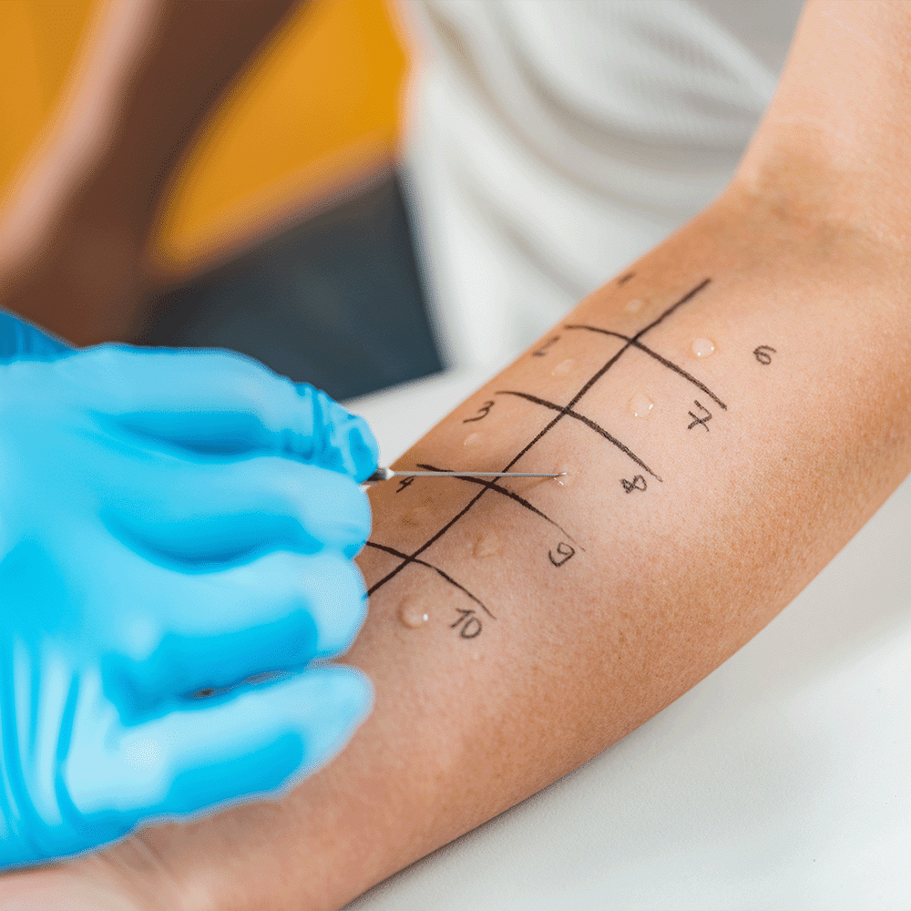 intracutaneous test on skin