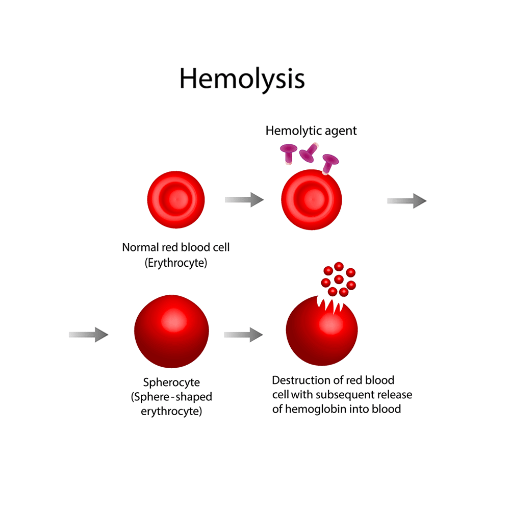 stages of hemolysis