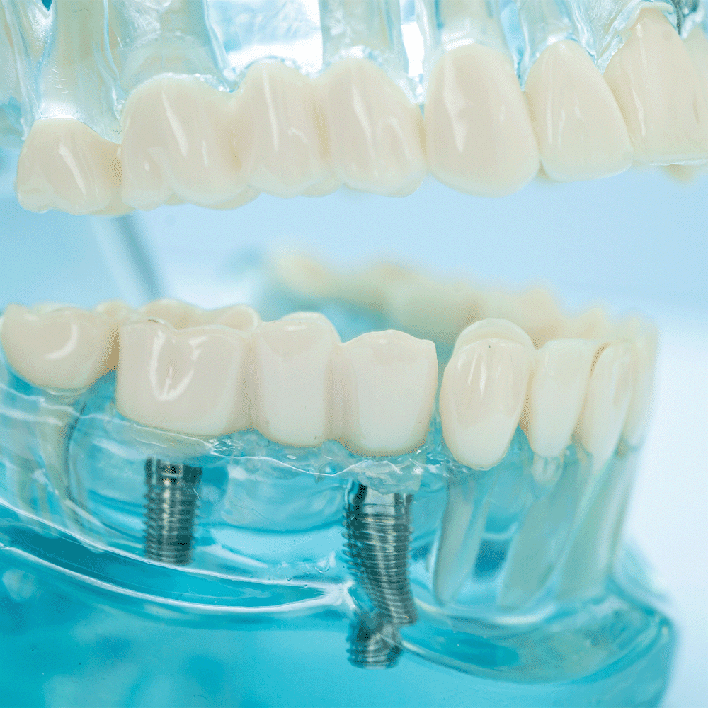 Dental model with tooth implants, illustrating ISO 10993-1 applications in medical-grade materials for safe and biocompatible use