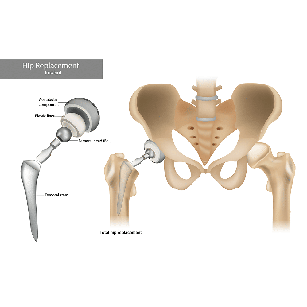 hip replacement implant schematic for assessing tribocorrosion in the form of wear and corrosion