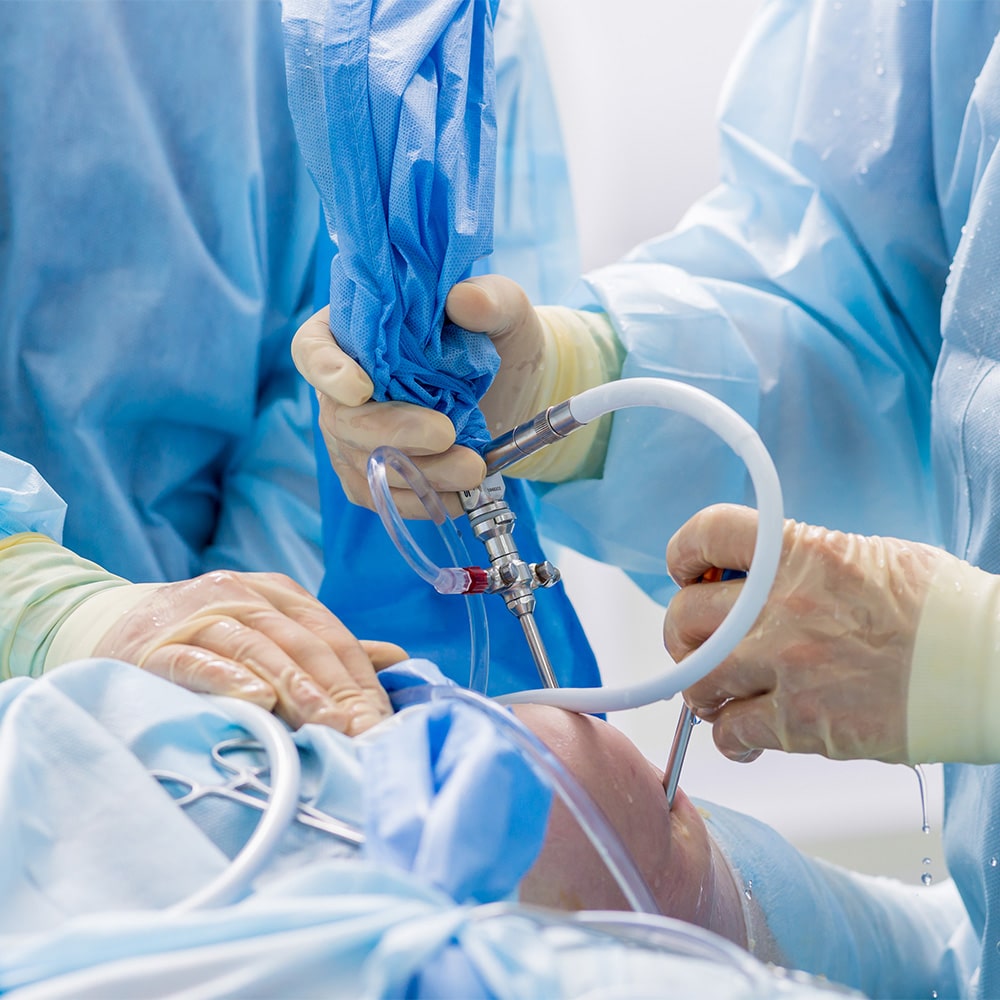 arthroscopic shaver and cutter being used during knee surgery